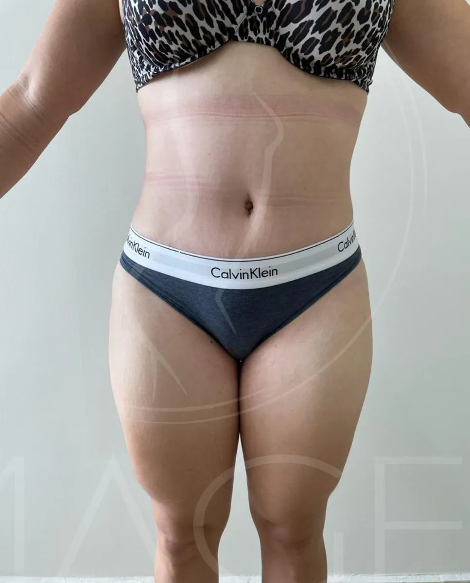 Después - Abdominoplastía mommy make over