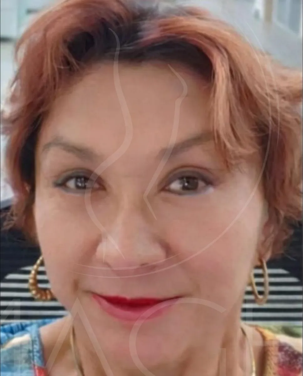 Después - Lifting facial
